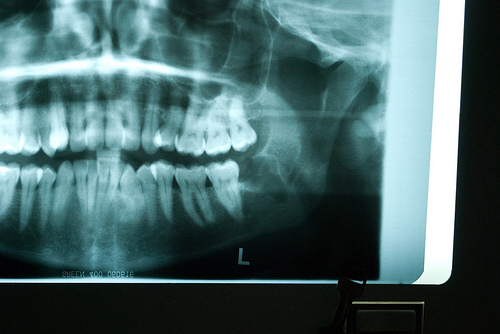 Extracted Wisdom tooth Extracted Wisdom tooth